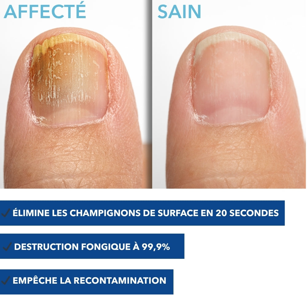MYCOFLASH® - Stylo de traitement pour mycoses des ongles