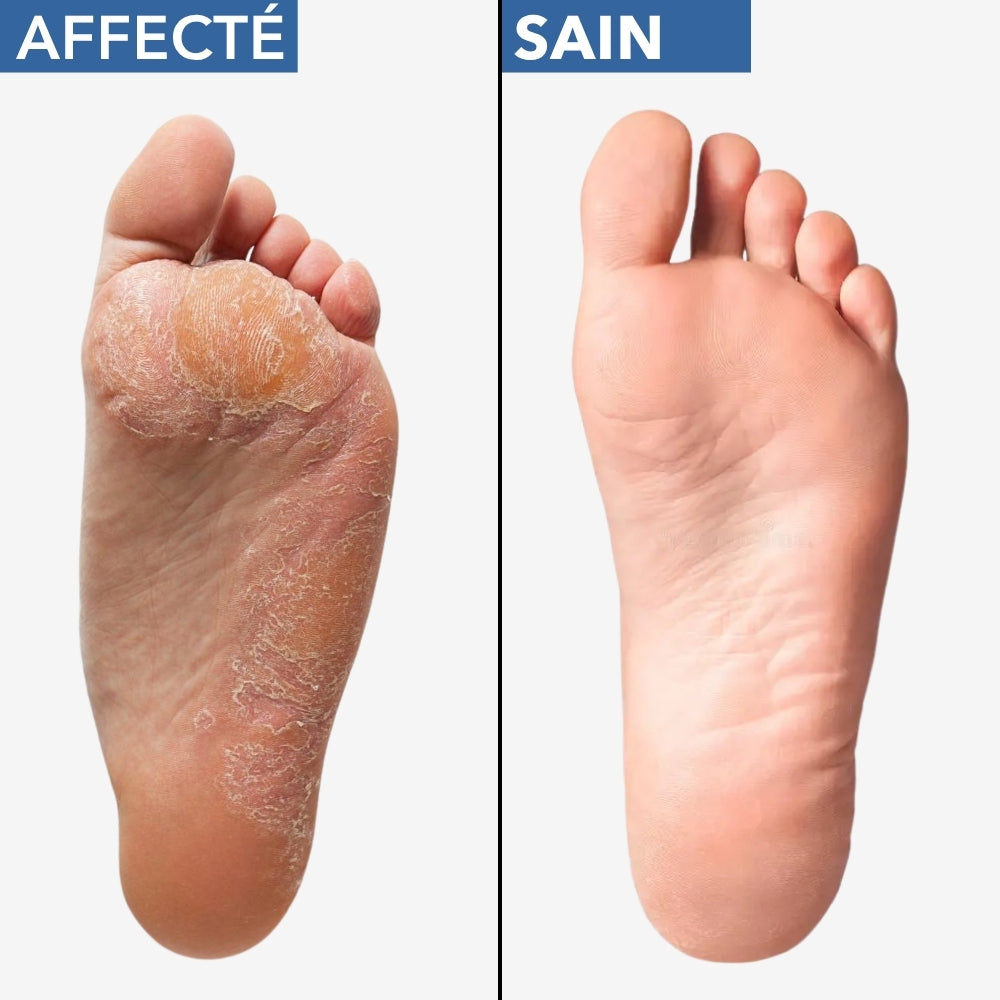 MYCOFLASH® - Spray Antifongique pour le Pied d'Athlète