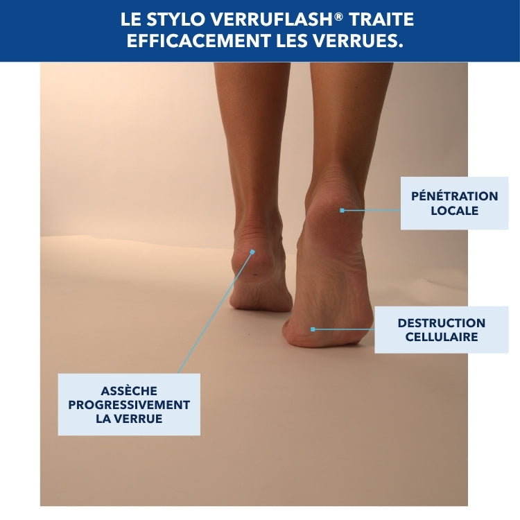VERRUFLASH® -  Stylo de traitement des verrues mains, pieds et corps